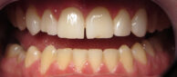 Before